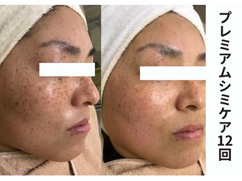 プレジール(plaisir)/シミケアコース