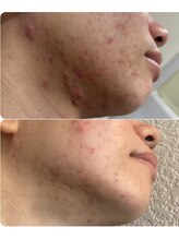 ハクビューティー(HAKU BEAUTY)/下に行けば行くほど手強い？