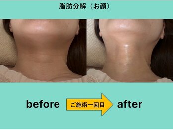 イロハ(1680 IROHA)の写真/【脱・マスク老け】二十アゴやたるみを根本改善！ダウンタイムなしの小顔脂肪分解で若々しい印象へ！