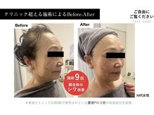 トモニ(TOMONI)/神経幹細胞×エクソソーム導入