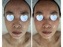 ルネ(Rune)/プラズマシャワー効果