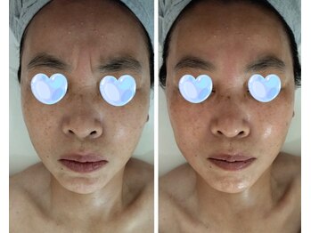 ルネ(Rune)/プラズマシャワー効果