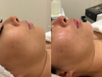 サンオーラ(SUN AURA)/徹底小顔/ビフォーアフター