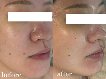 ホワイトアクア 北千住店(WHITE AQUA)/ララピール/赤み/乾燥