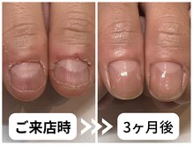 ケアリ(CAREri)の雰囲気(注目の【美爪育成コース】で長く悩んでいた深爪がここまで改善)