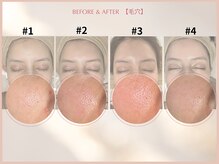 シンスプラス(SINCE+)/毛穴集中改善コース