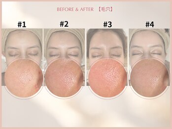 シンスプラス(SINCE+)/毛穴集中改善コース