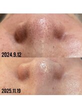 ビーマジック(Be Magic)/毛穴/毛穴洗浄/小顔/黒ずみ