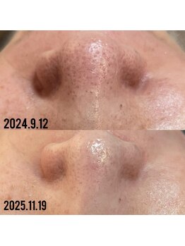 ビーマジック(Be Magic)/毛穴/毛穴洗浄/小顔/黒ずみ