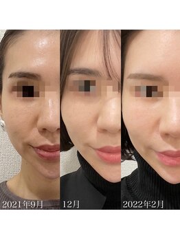 ラ クレール ビューティーサロン(LA CLAIR)/症例(シミケア)