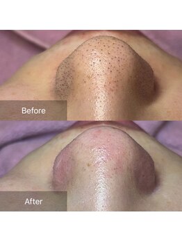 癒える(ielu)/毛穴エクストラクションBA