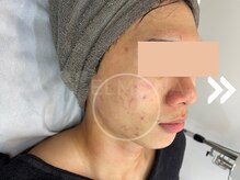 グリーンピール エルモナ(GREENPEEL ELMONA)/【グリーンピールレスベラ】