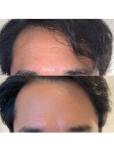 メディカル サンテロッソ(MEDICAL SANTEROSSO)/高濃度エクソソームフェイシャル