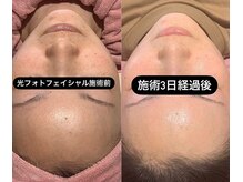 メディカルサロン ティアラ 亀有本店/光フォト.フェイシャル/美肌美白