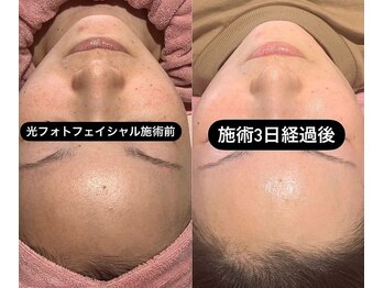 メディカルサロン ティアラ 亀有本店/光フォト.フェイシャル/美肌美白