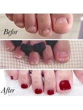 リミズネイルビューティー 名駅店(RimisNailxbeauty)/【美爪育成】《フット》深爪改善
