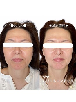 ボン セジュール(Bon sejour)/レチノールララピール