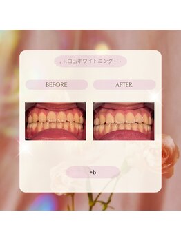 プラスビー 2号店(+b)/ホワイトニングビフォーアフター