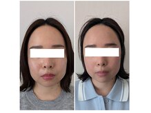 ゆずのはな/たった2回での変化です！