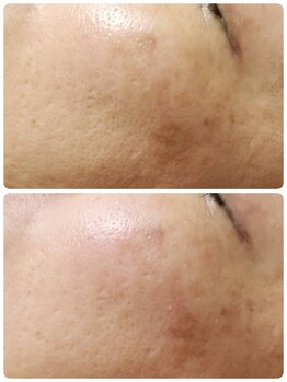 リノア 堀江(Linoa)/毛穴洗浄＆ハーブピーリング