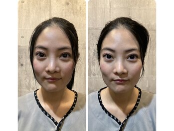 メディック(MEDIC)/小顔モニター　by湯島ちょこさん