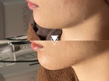 【二重あご/ほうれい線】高密度超音波リフトアップで若々しい印象へ◎凹凸改善にも!スポットフィット￥9980