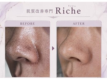 リッシュ(Riche)の写真/毛穴やニキビなどお肌のお悩みへ集中アプローチ☆ハーブピーリング/毛穴洗浄◎肌質改善と癒やしのエステ