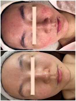 サロンドミュウ(Salon de Mieux)の写真/【ぴかぴか毛穴を目指したい方】本気の肌質改善で開いた毛穴にアプローチ、毛穴レスのお肌を目指せます♪