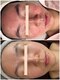 サロンドミュウ(Salon de Mieux)の写真/【ぴかぴか毛穴を目指したい方】本気の肌質改善で開いた毛穴にアプローチ、毛穴レスのお肌を目指せます♪