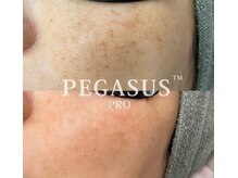 エタニティ 西宮店(Eternity)/IPL光エステ