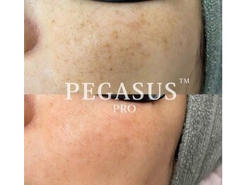 エタニティ 西宮店(Eternity)/IPL光エステ