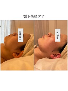 ファミーユ 名古屋店/【顎下術後ケア】吸引後ケア