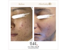 ビセラ(Vicella)の雰囲気（ 【ハーブピーリング】リピーター続出！どんなお肌悩みにも◎）
