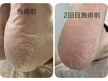 ロンディネ(Rondine)/韓国最新角質ケア・s-planing