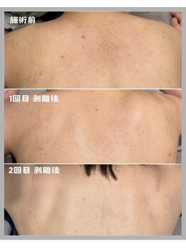 メイリリー 新宿(Meilily)/【背中ニキビケア】ビフォアフ