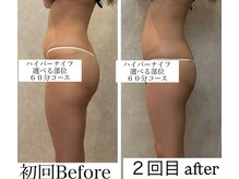 レイ(Ray)/下半身痩せヒップアップ