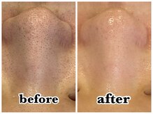 サロン ド ビューティフルール(Salon de beaute Fleur)/毛穴洗浄：ハイドロスプラッシュ