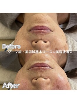 リープラス 赤坂(Re-plus)/ダーマ鍼《乾燥・くすみ改善》