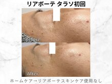 リライン(ReLine)/【リアボーテ　タラソ初回】