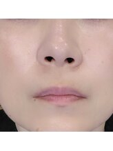 プチリュクス(Petit Luxe)/毛穴すっきりコース