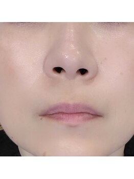 プチリュクス(Petit Luxe)/毛穴すっきりコース