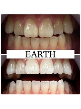 アース(EARTH)/【ビフォーアフター】美白