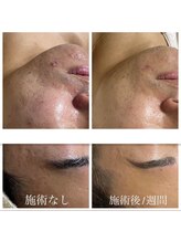 オルネ(ORNE.)/【韓国美容】NK細胞美容