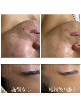 オルネ(ORNE.)/《NK細胞美容》