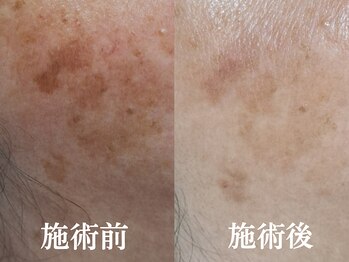 エレヌイ(ELENUI)/最新光フェイシャル★シミ改善