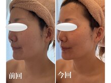 美バストアルファ(美bust α)/【小顔コルギ&バストアップ】