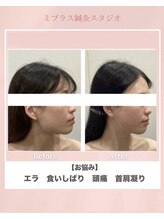 ミプラス鍼灸スタジオ/ビフォーアフター