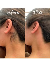 アンベリール(embellir)/うなじ脱毛