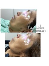 ラウリーベ(Rau Liebe)/プラズマ1回／50代