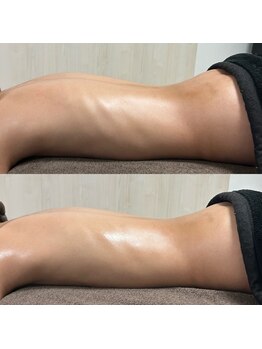 リンデザ(Lindeza)/1回度の施術です